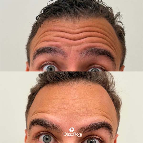 Toxina Botulínica2