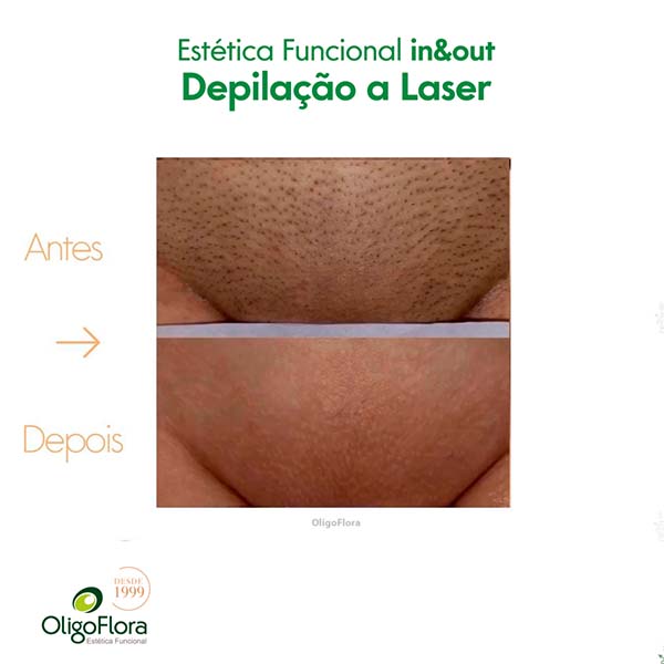 depilação a laser1