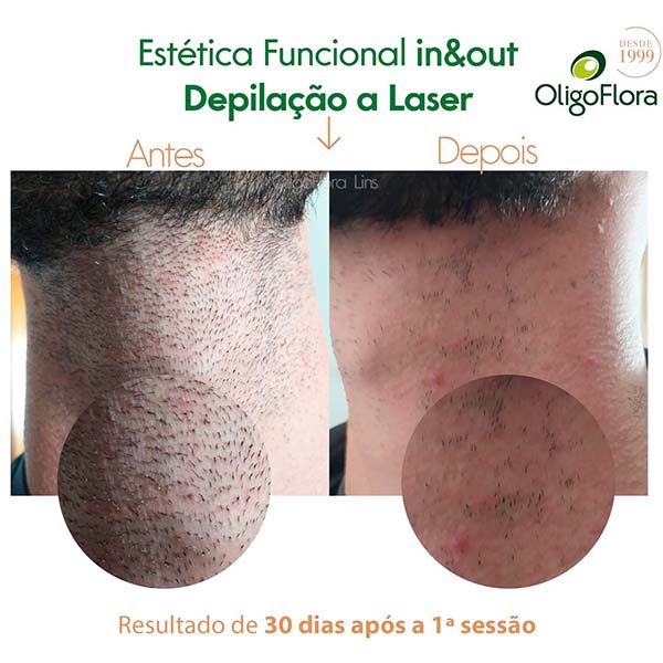 depilação a laser3