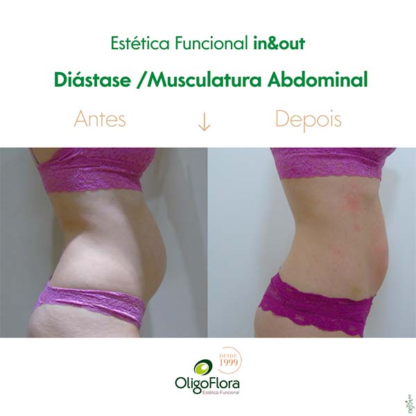 diástase abdominal2
