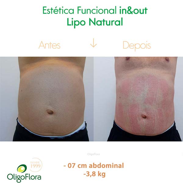 lipo sem cortes2