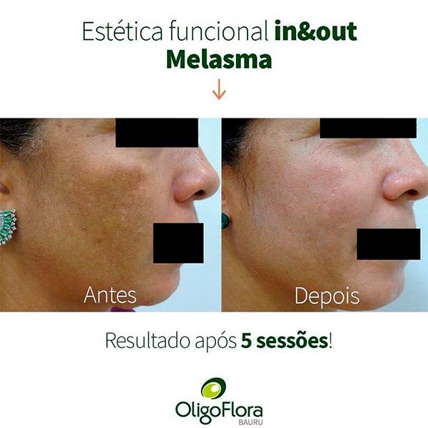 melasma1