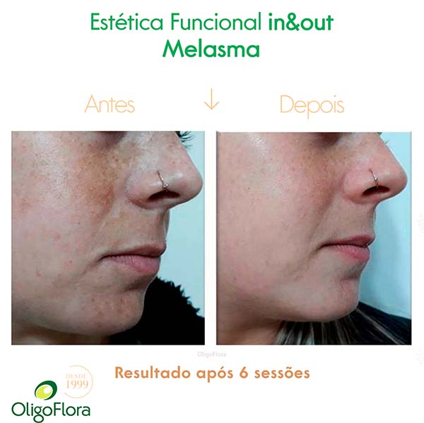 melasma2