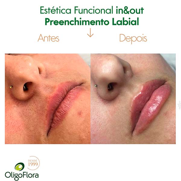 preenchimento labial2