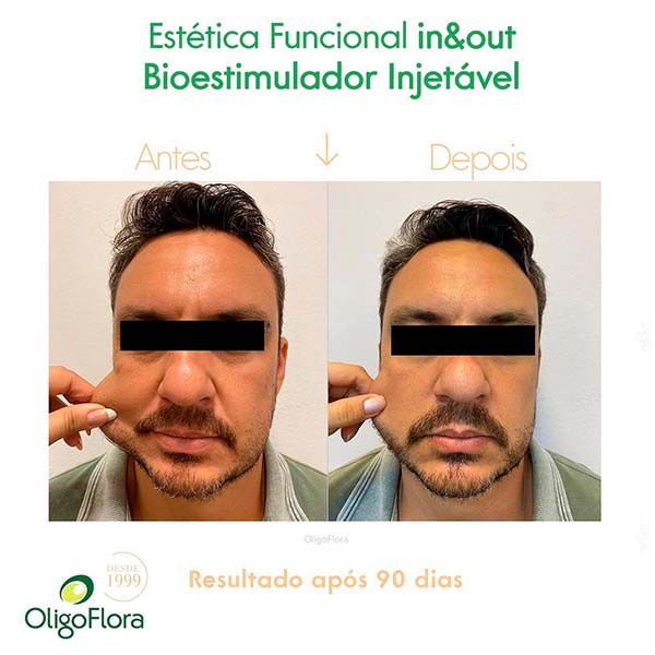 Microagulhamento
