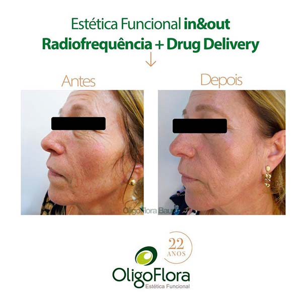 Radiofrequência
